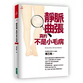 靜脈曲張，真的不是小毛病