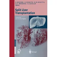 Split Liver Transplantation: Theoretical and Practical Aspects