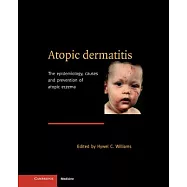 Atopic Dermatitis