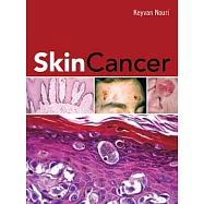 Skin Cancer