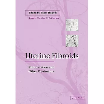 Uterine Fibroids: Embolization and Other Treatments