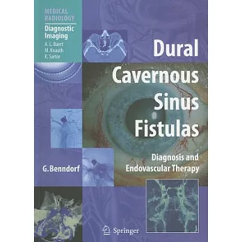 Dural Cavernous Sinus Fistulas: Diagnosis and Endovascular Therapy