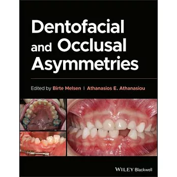 Dentofacial and Occlusal Asymmetries