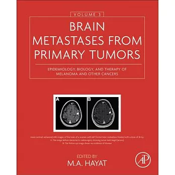 Brain Metastases from Primary Tumors: Epidemiology, Biology, and Therapy of Melanoma and Other Cancers