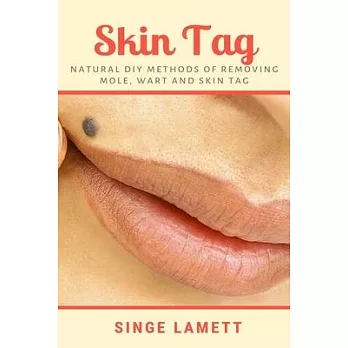 Skin Tag: Natural DIY Methods of removing Mole, Wart and Skin Tag